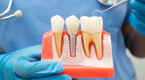 representação de 3 dentes, faculdade de odontologia
